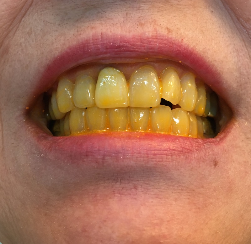 yellow teeth smile